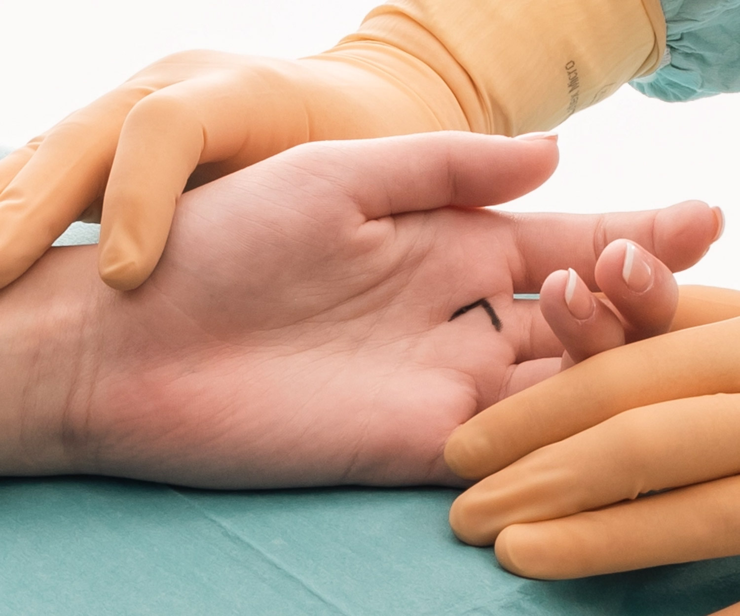 my clinique chirurfie de la main doigt a ressaut