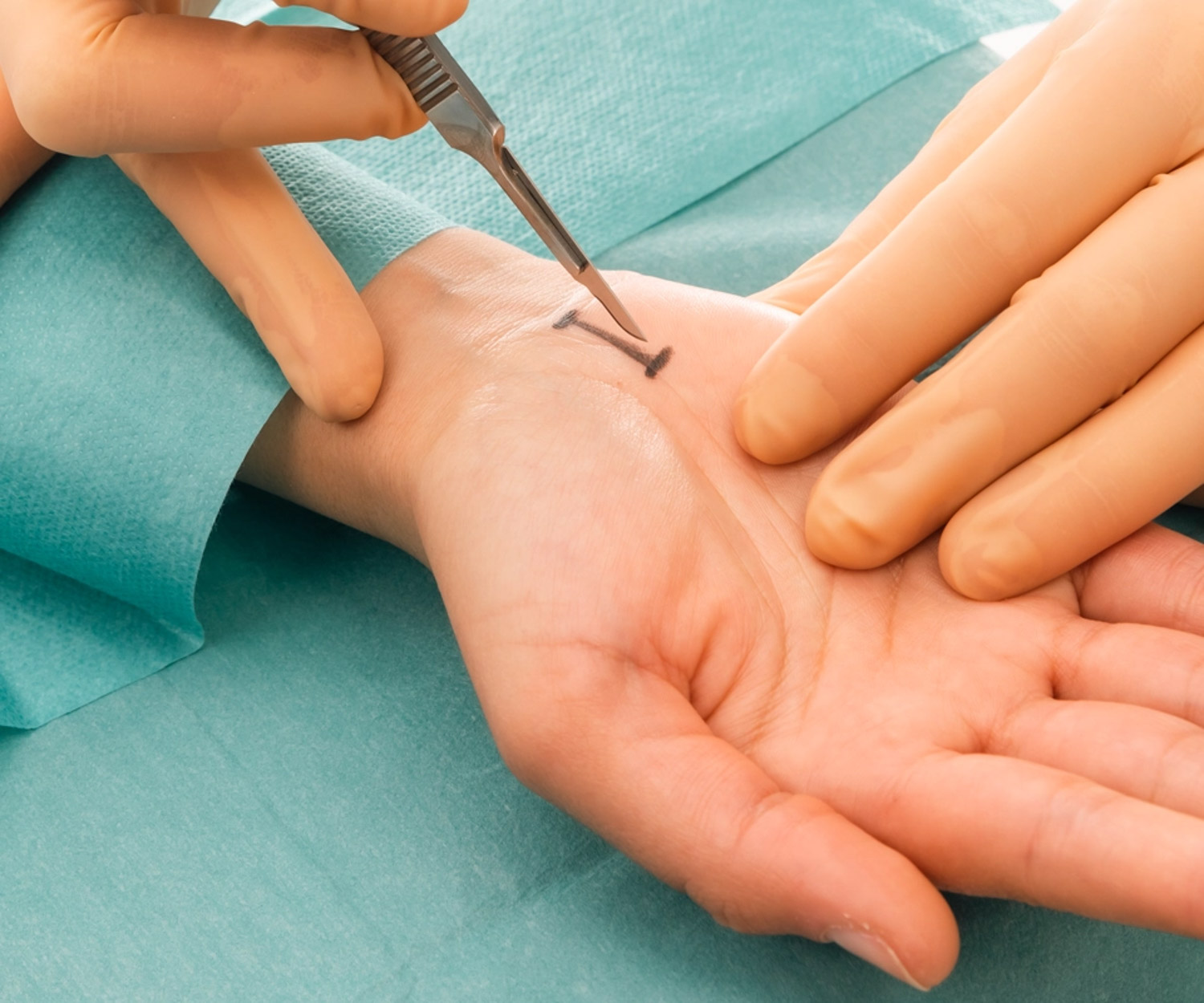 my clinique chirurgie de la main syndrome du canal carpien