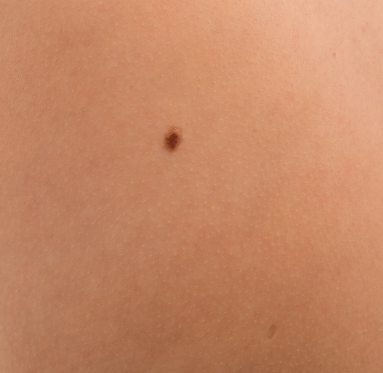 my clinique chirurgie de la main tumeurs benignes