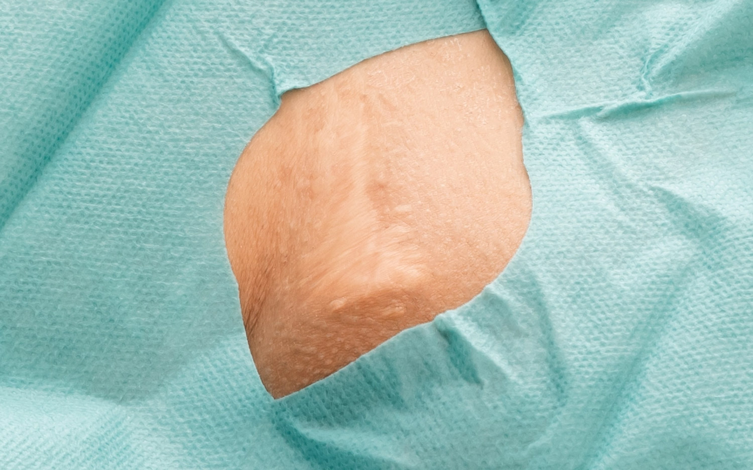 my clinique lesions cutanees cicatrices