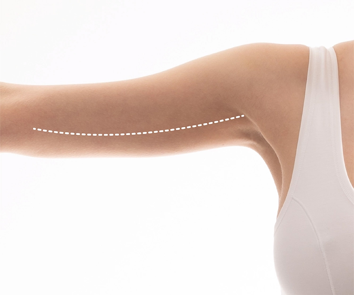 my clinique silhouette lifting des bras