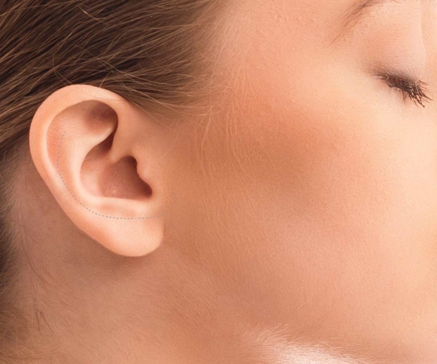 my clinique visage otoplastie