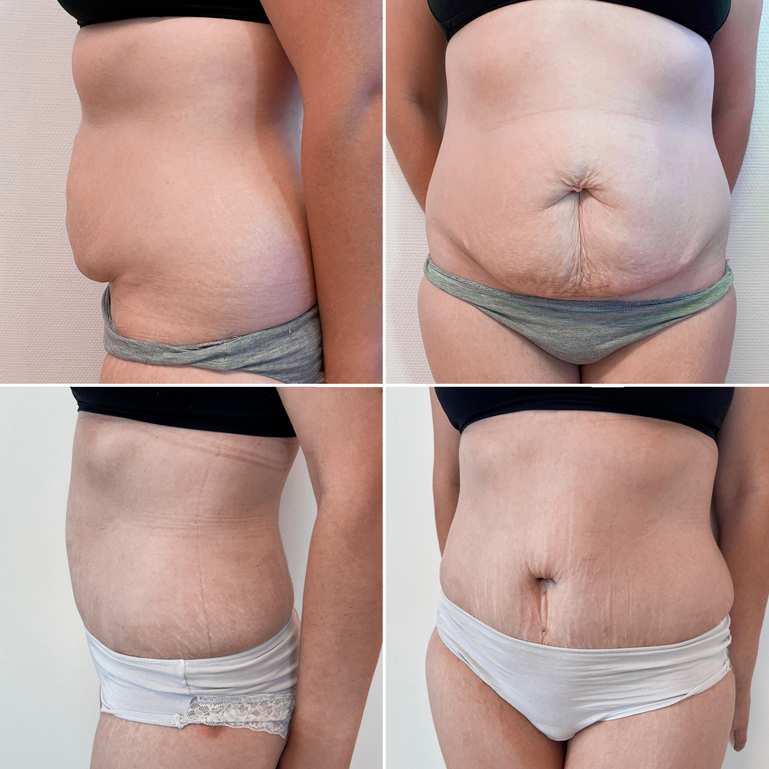 My clinique avant après 0000 adominoplastie