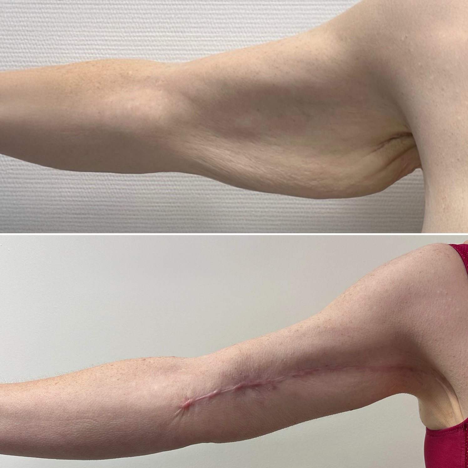 My clinique avant après 0012 brachioplastie