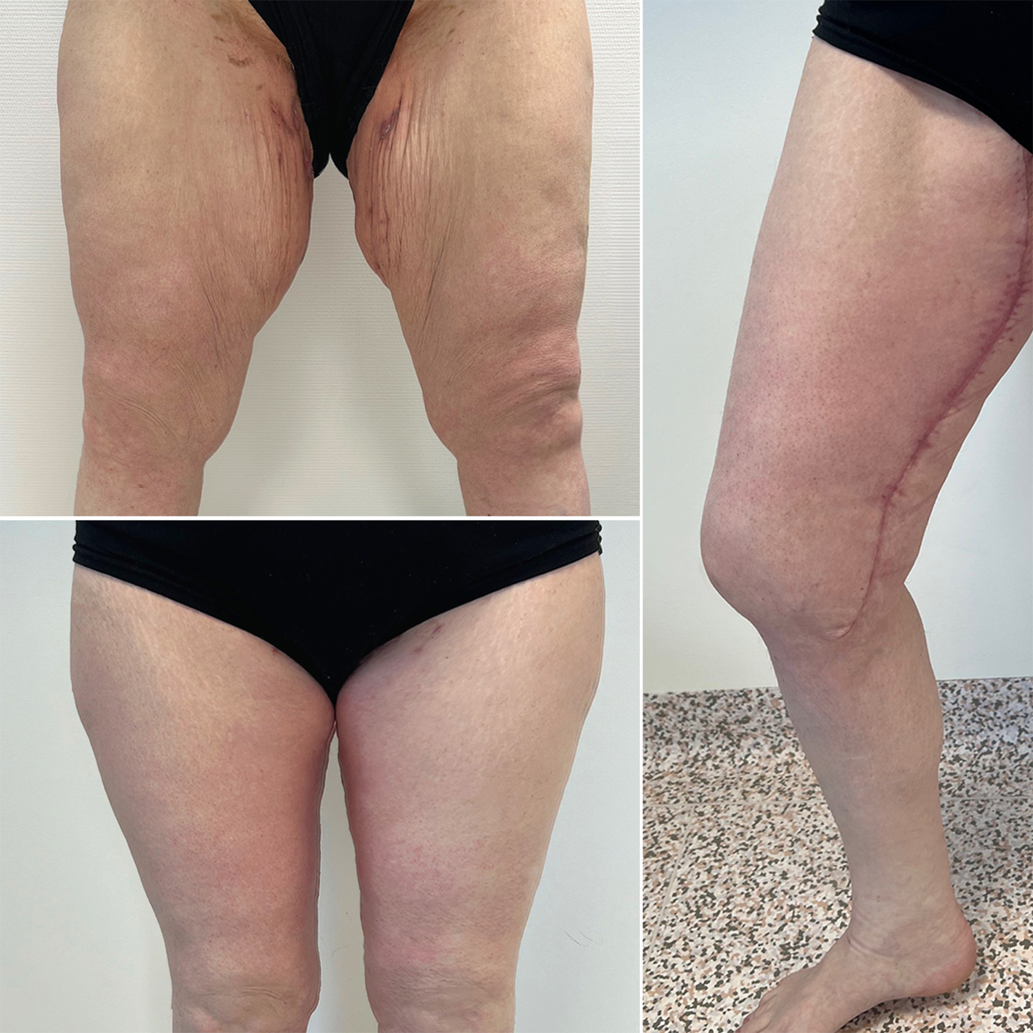 My clinique avant après 0005 cruroplastie