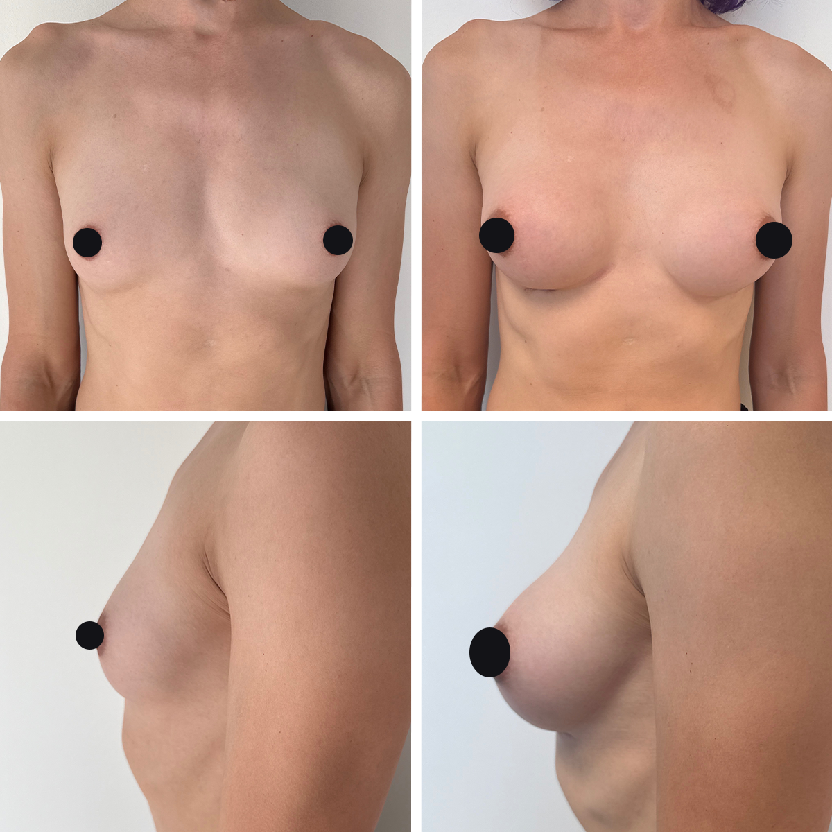 transition de genre mammoplastie avant après